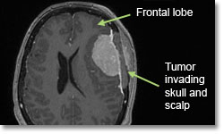 Менингиомы фронтальной доли. Локализация - конвекситально (на поверхности головного, мозга вдали от срединной линии)