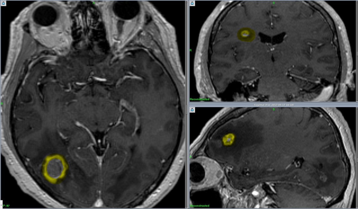 Множественные метастазы в головной мозг у пациента с первичным раком почки