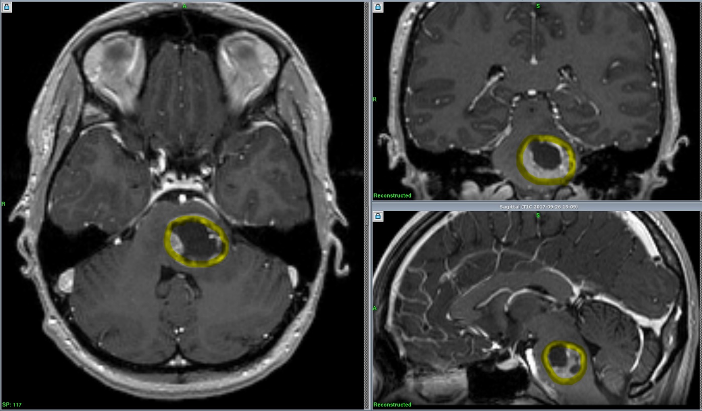 Метастаз рака груди в головной мозг на снимке МРТ с контрастом