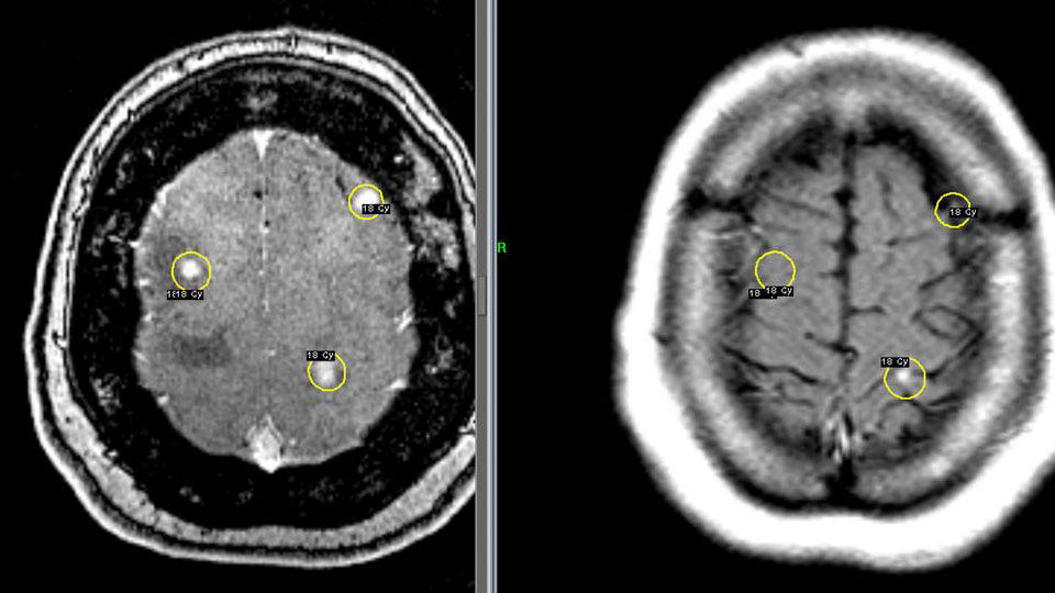 Эффективность лечения метастазов рака груди в головной мозг на Гамма-ноже: На контрольном МРТ через 1 месяц после операции (справа) отмечается положительная динамика (6 очагов не визуализируются, у 14 очагов снижение размеров).