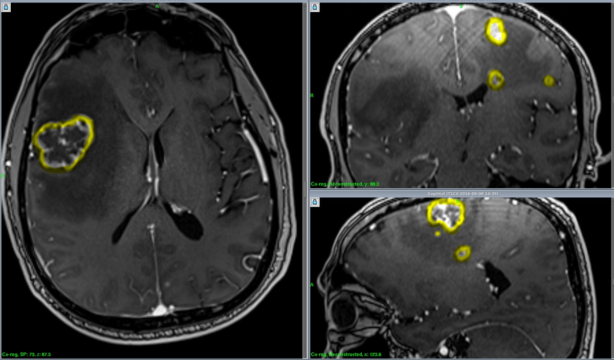 Метастазы в головной мозг на МРТ: снимки пациента, который лечил рак легкого методом нетрадиционной медицины, а затем обратился в Онкологическую клинику МИБС для лечения метастазов в мозг
