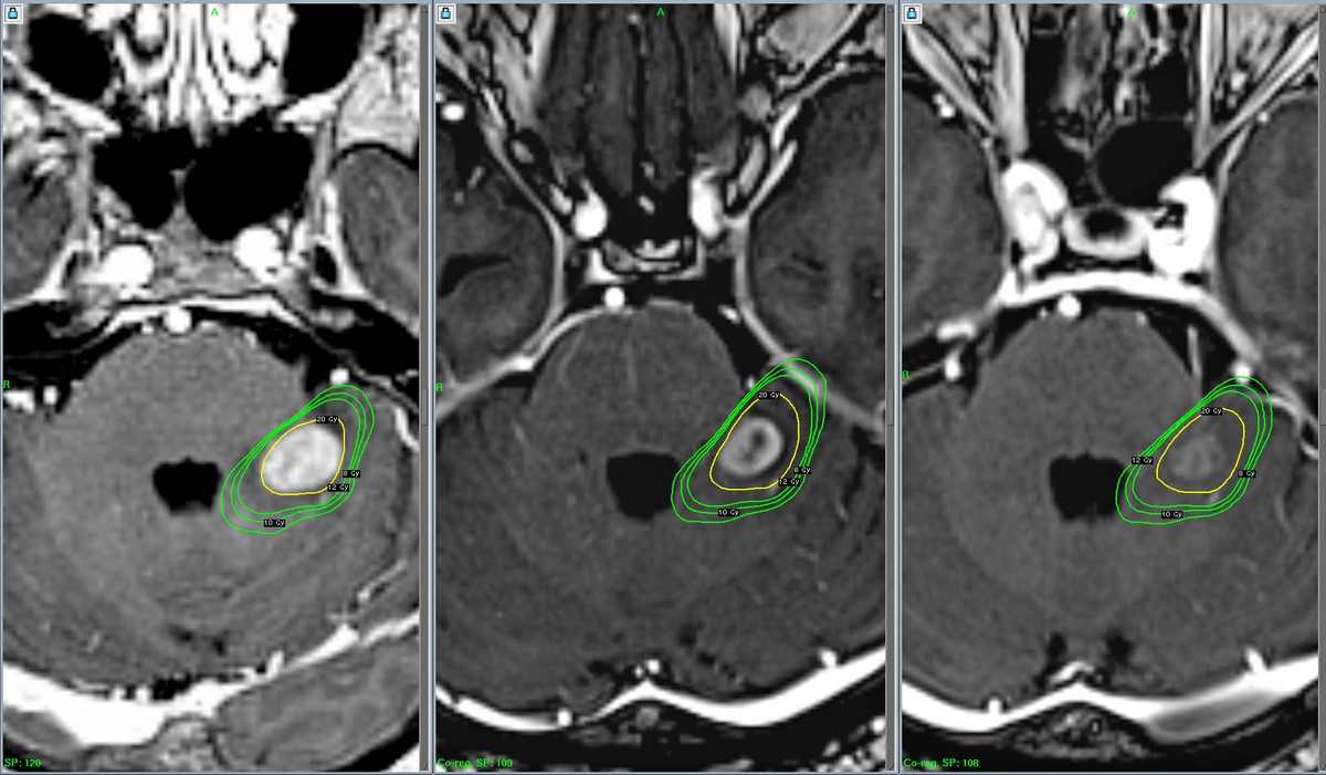Метастаз меланомы в головной мозг. Мужчина, 59 лет. Зеленые линии – критические (значимые) дозы за пределами мишени. Лечение на Гамма-ноже проведено таким образом, чтобы снизить нагрузку на важную структуру – ствол головного мозга. Левый снимок – день лечения, в центре – через 4 месяца, справа – через 8 месяцев. Новообразование не демонстрирует накопление контраста.