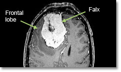 Менингиомы фронтальной доли. Локализация – на фальксе (опухоль, возникающая на мозговой оболочке между двумя полусферами мозга)