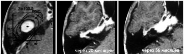Выраженное уменьшение невриномы лицевого нерва через 20 и 56 месяцев после радиохирургии с помощью Гамма-ножа