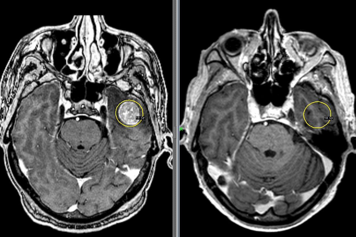 Метастазы в головной мозг: лечение на Гамма-ноже в Клинике МИБС