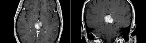 МРТ больного с примитивной нейроэктодермальной опухолью пинеальной области до лечения на Гамма Ноже