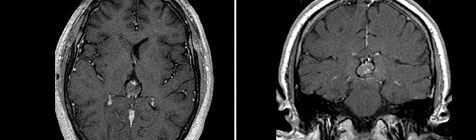 МРТ пациента через 35 месяцев после лечения на Гамма Ноже