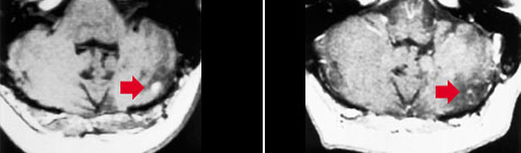 Слева: Магнитно-резонансная томограмма больного гемангиобластомой мозжечка до лечения на Гамма-ноже