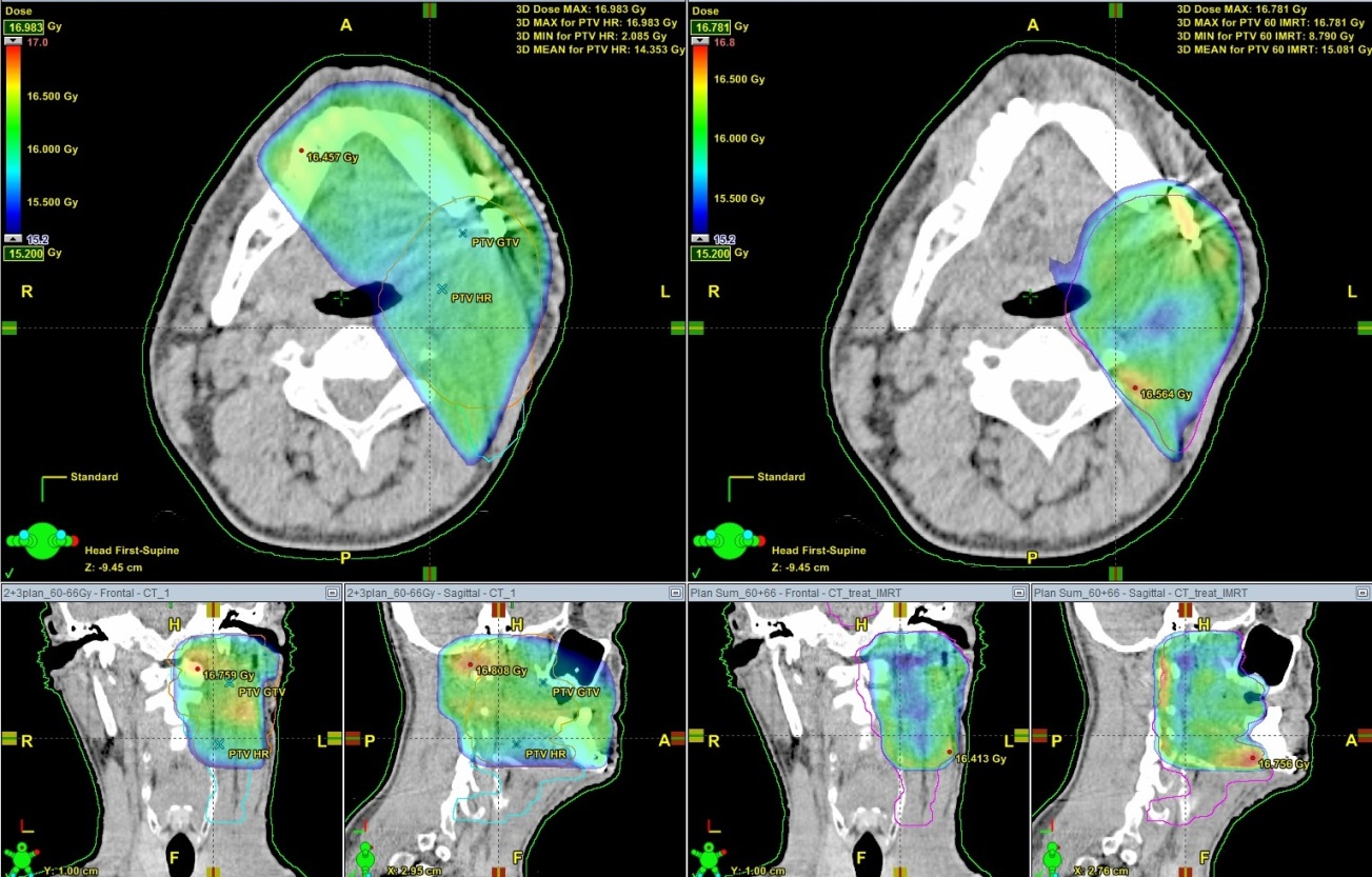 Распределение дозы в облучаемом объеме и снижение нагрузки на здоровые ткани (IMRT - справа). Рис.1