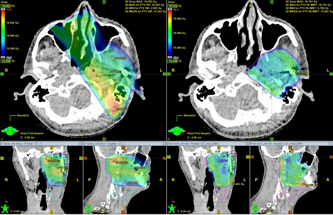 Распределение дозы в облучаемом объеме и снижение нагрузки на здоровые ткани (IMRT - справа). Рис.2